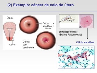 (2) Exemplo: câncer de colo do útero
Útero
Cervix
saudável
Cervix
com
carcinoma
Esfregaço celular
(Exame Papanicolau)
Célula saudável
 