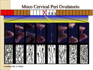 Gentileza Dr. J. Neira Moco Cervical Peri Ovulatorio 1 2 3 