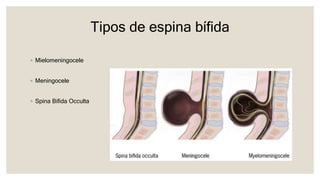 Tipos de espina bífida
◦ Mielomeningocele
◦ Meningocele
◦ Spina Bifida Occulta
 