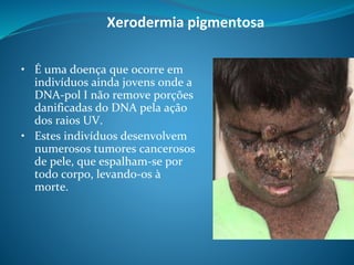Xerodermia pigmentosa
• É uma doença que ocorre em
indivíduos ainda jovens onde a
DNA-pol I não remove porções
danificadas do DNA pela ação
dos raios UV.
• Estes indivíduos desenvolvem
numerosos tumores cancerosos
de pele, que espalham-se por
todo corpo, levando-os à
morte.
 
