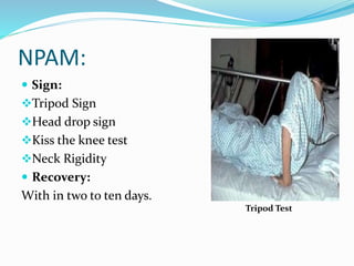 NPAM:
 Sign:
Tripod Sign
Head drop sign
Kiss the knee test
Neck Rigidity
 Recovery:
With in two to ten days.
Tripod Test
 