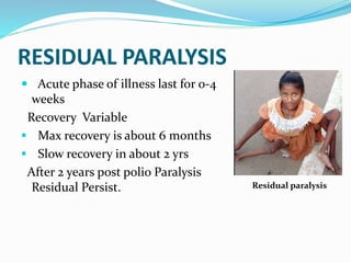 RESIDUAL PARALYSIS
 Acute phase of illness last for 0-4
weeks
Recovery Variable
 Max recovery is about 6 months
 Slow recovery in about 2 yrs
After 2 years post polio Paralysis
Residual Persist. Residual paralysis
 