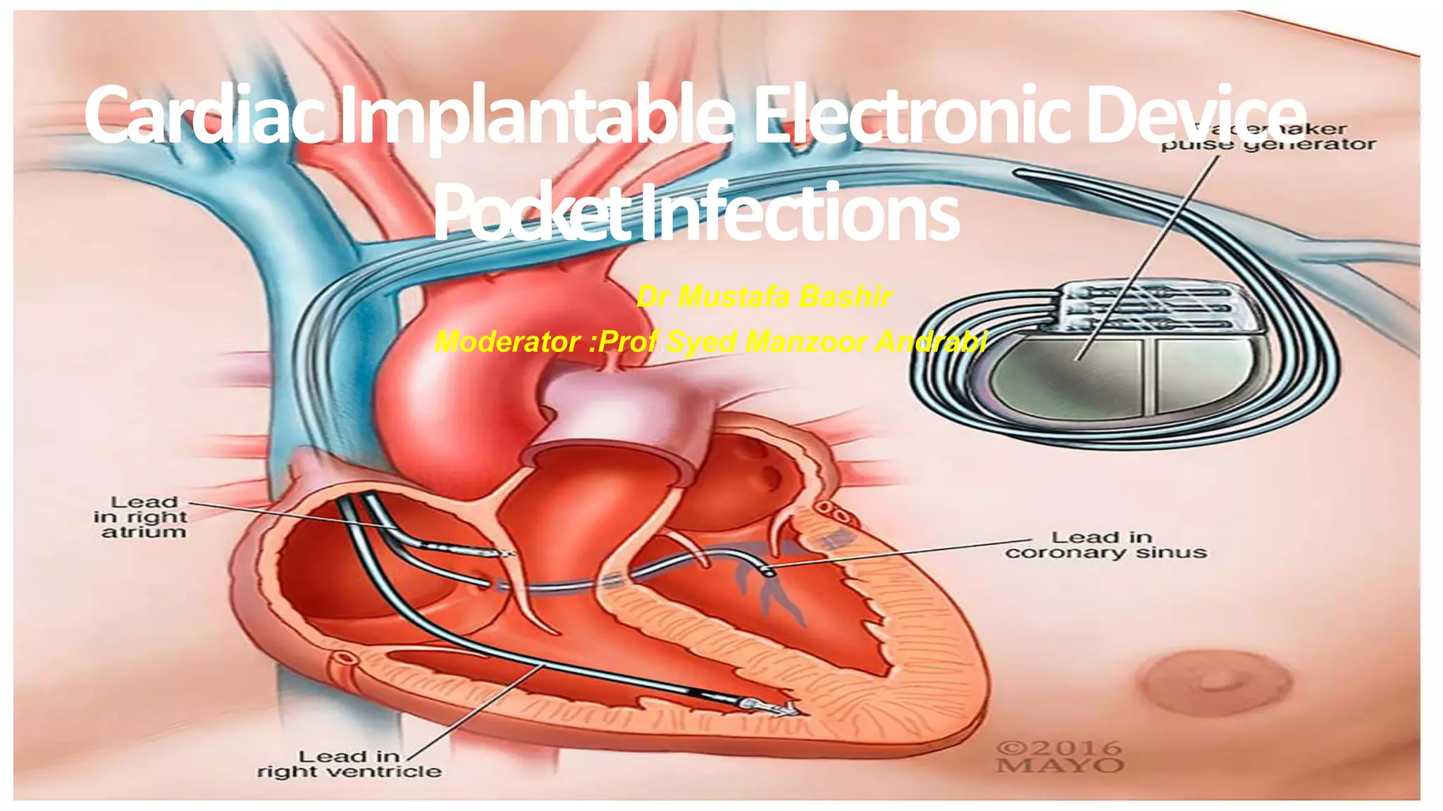CIED POCKET INFECTION.pptx | Infectious Diseases | Diseases and Conditions