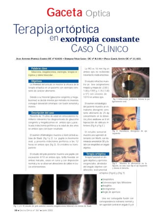 Gaceta Optica
10 x GACETA OPTICA Nº 361 x Junio 2002
CASO CLÍNICO
Terapia
en exotropía constante
ortóptica
Palabras clave
Glaucoma, megalocornea, exotropia, terapia or -
tóptica y visión binocular .
Objetivos
La finalidad del articulo es mostrar la eficacia de la
terapia ortóptica en un paciente con exotropia cons-
tante de carácter alternante.
Debido a su historial (glaucoma congénito y mega-
locornea) se decide intentar por métodos no invasivos
conseguir desviación ortotropia con fusión sensorial y
motora.
Descripción del caso
Paciente de 15 años de edad sin antecedentes fa-
miliares relevantes fue diagnosticado de glaucoma
congénito y megalocornea en ambos ojos y prac-
ticada iridiectomia periférica a la edad de dos años
en ambos ojos con buen resultado.
El examen oftalmológico muestra a nivel corneal es -
trías de Haab (fig 1y 2). La pupila es levemente
oval, y presenta iridectomía periférica a las 12
horas en ambos ojos (fig 3). El cristalino es trans-
parente.
El estudio del polo posterior muestra una papila con
escavación 4/10 en ambos ojos, brillo foveolar en
ambas máculas, vasos en curso y con disposición
normal y no se observan alteraciones de calibre ni cru-
ces arteriovenosos
La PIO es 16 mm Hg en
ambos ojos no recibiendo
tratamiento medicamentoso.
El estudio refractivo mues-
tra un leve astigmatismo
miópico y miopía de –2.00 (-
1.00 a 170º) y -1.75 (-1.00
a 5º) con visiones de
10/10 en ambos ojos.
El examen estrabológico
del paciente muestra un es-
trabismo divergente cons-
tante alternante de 25 dp
concomitante en la distan-
cia y leve síndrome en V sin
hiperacción de oblicuos in-
feriores (Fig.4 y Fig.5 ).
El estudio sensorial.
muestra una supresión al-
ternante con Worth, con do-
minancia sensorial de OD y fu-
sión con sinoptóforo en ángulo
objetivo.
Terapia ortóptica
Terapia fusional en án-
gulo objetivo y ejercicios
vergenciales alrededor
del ángulo objetivo con
diferente instrumental
ortóptico (Fig.6) y (Fig.7).
Sinoptóforo
Estereoscopio tipo Whestone
Anáglifos
Vectogramas
Regla de apertura
Una vez conseguida fusión con
correspondencia retiniana normal y
sin supresión central en ángulo 0 y el
Fig 1 y 2. El estudio de polo anterior muestra megalocornea bilateral con estrías de Haab
Fig.5 Muestra la alternancia en la
fijación, en este caso fija el ojo izquierdo
y desvía el derecho
Fig 4. Estrabismo divergente de ojo
izquierdo
Fig 3 Iridectomia periférica. Notese la pup
ligeramente oval
JUAN ANTONIO PORTELA CAMINO OC Nº 6.616 • ENRIQUEZ VÉLEZ LASSO OC Nº 8.144 • PAULA GARCÍA ANTÓN OC Nº 11.455
 