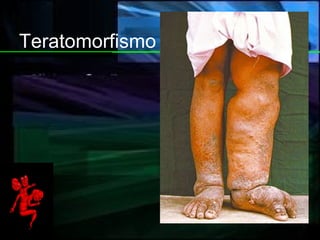 Teratomorfismo 
