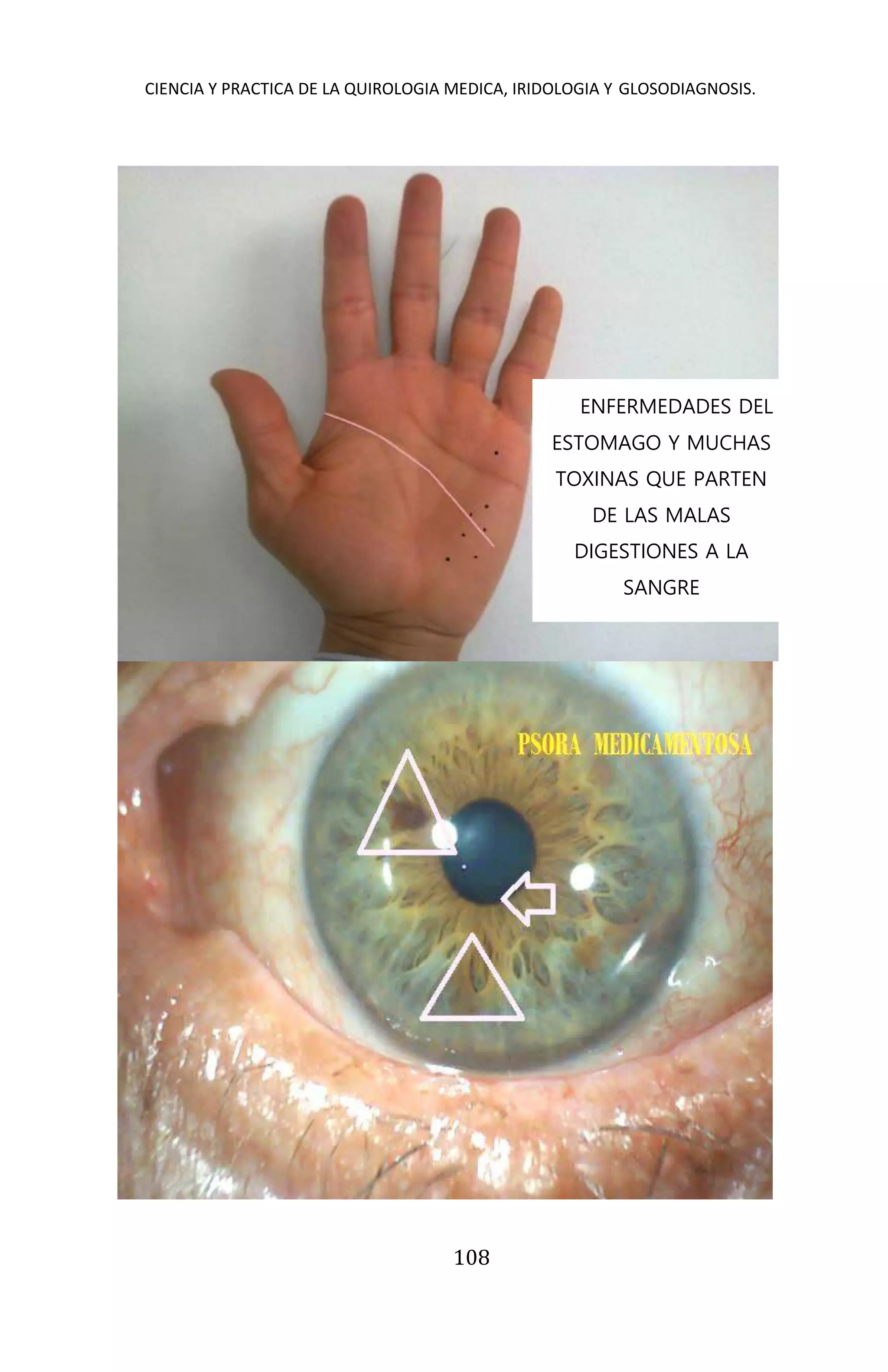 CIENCIA Y PRACTICA DE LA QUIROLOGIA MEDICA, IRIDOLOGIA Y GLOSODIAGNOSIS.
108
ENFERMEDADES DEL
ESTOMAGO Y MUCHAS
TOXINAS QUE PARTEN
DE LAS MALAS
DIGESTIONES A LA
SANGRE
 