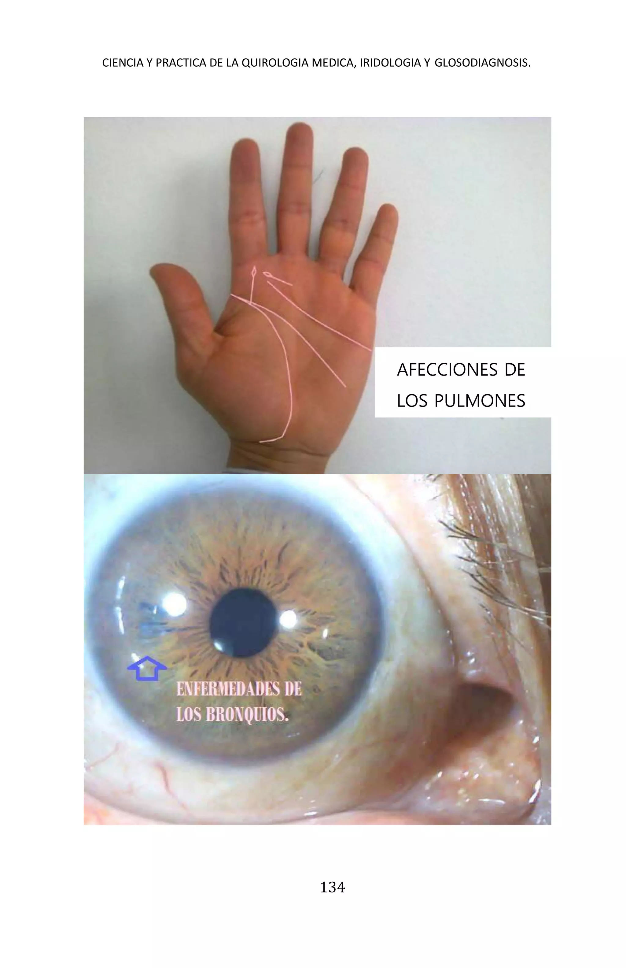 CIENCIA Y PRACTICA DE LA QUIROLOGIA MEDICA, IRIDOLOGIA Y GLOSODIAGNOSIS.
134
AFECCIONES DE
LOS PULMONES
 