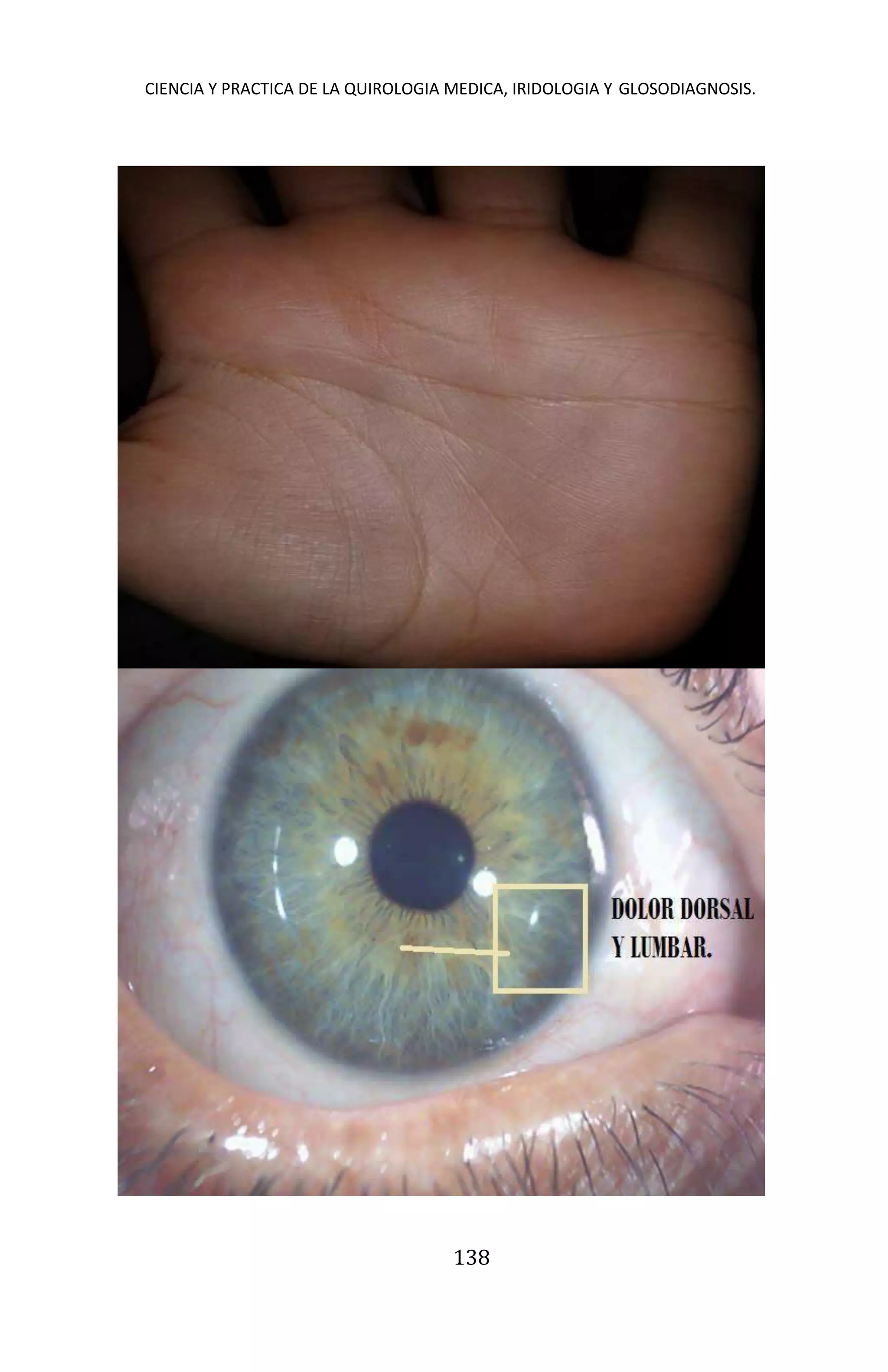 CIENCIA Y PRACTICA DE LA QUIROLOGIA MEDICA, IRIDOLOGIA Y GLOSODIAGNOSIS.
138
 