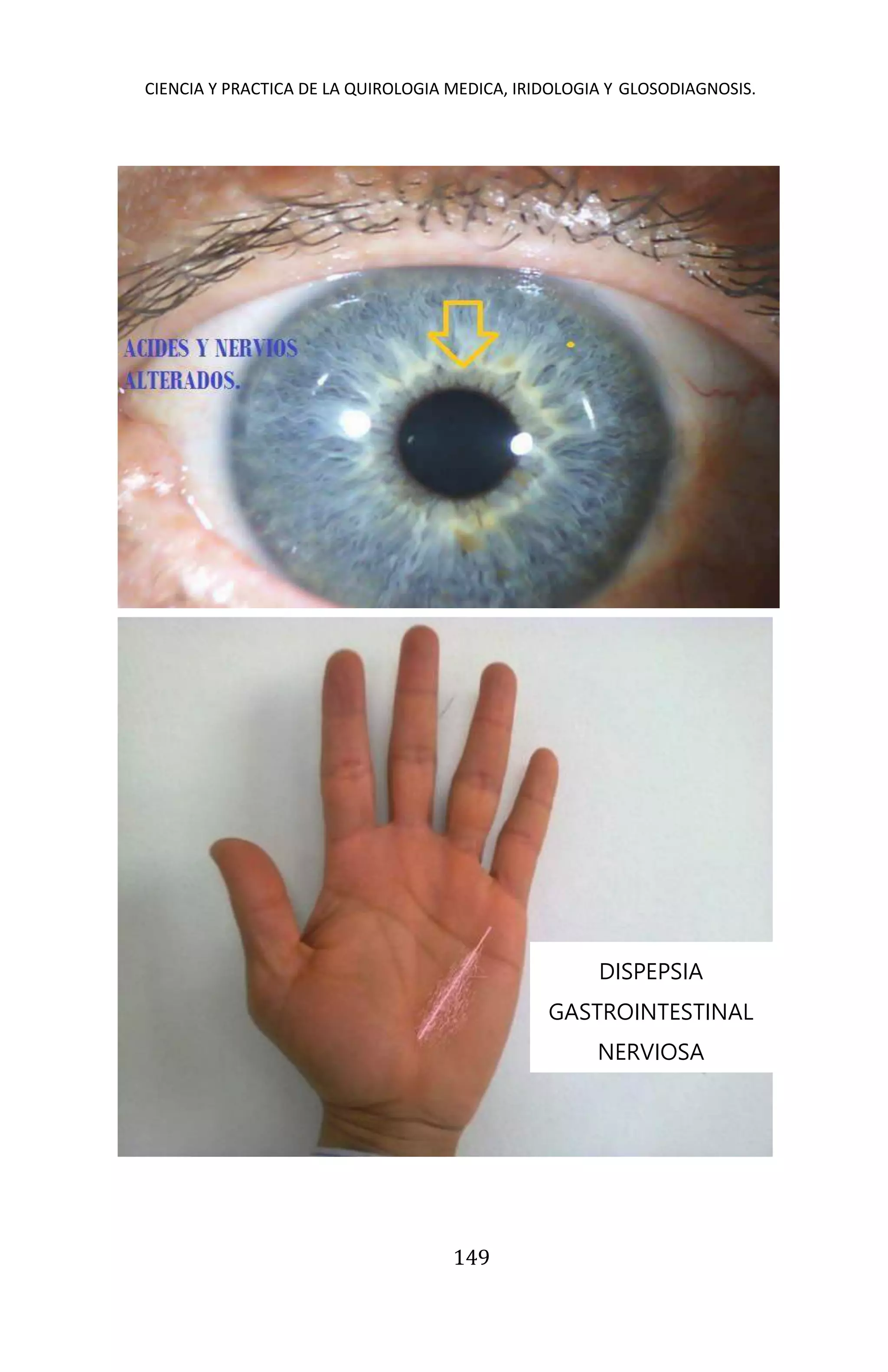 CIENCIA Y PRACTICA DE LA QUIROLOGIA MEDICA, IRIDOLOGIA Y GLOSODIAGNOSIS.
149
DISPEPSIA
GASTROINTESTINAL
NERVIOSA
 