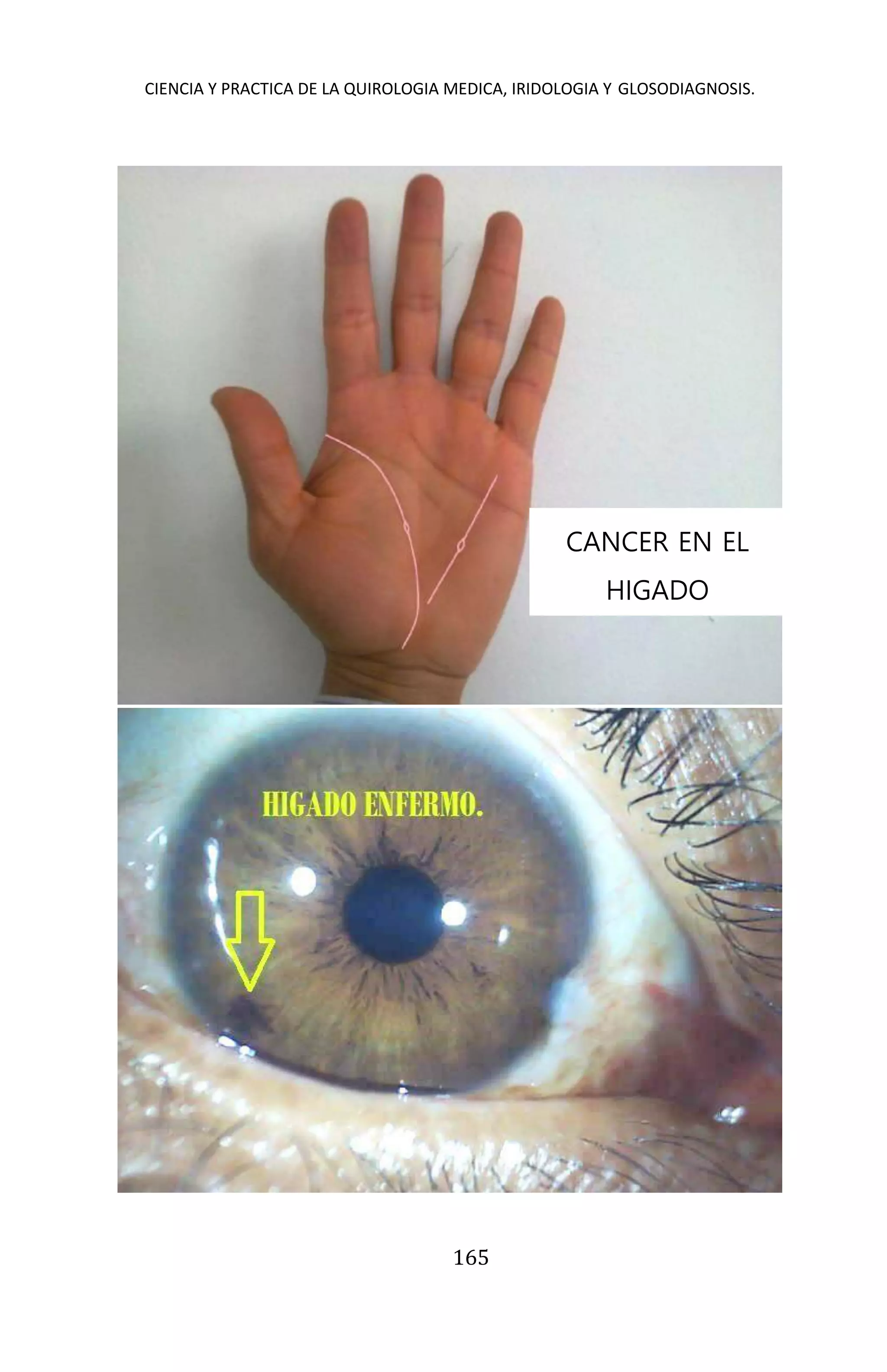 CIENCIA Y PRACTICA DE LA QUIROLOGIA MEDICA, IRIDOLOGIA Y GLOSODIAGNOSIS.
165
CANCER EN EL
HIGADO
 
