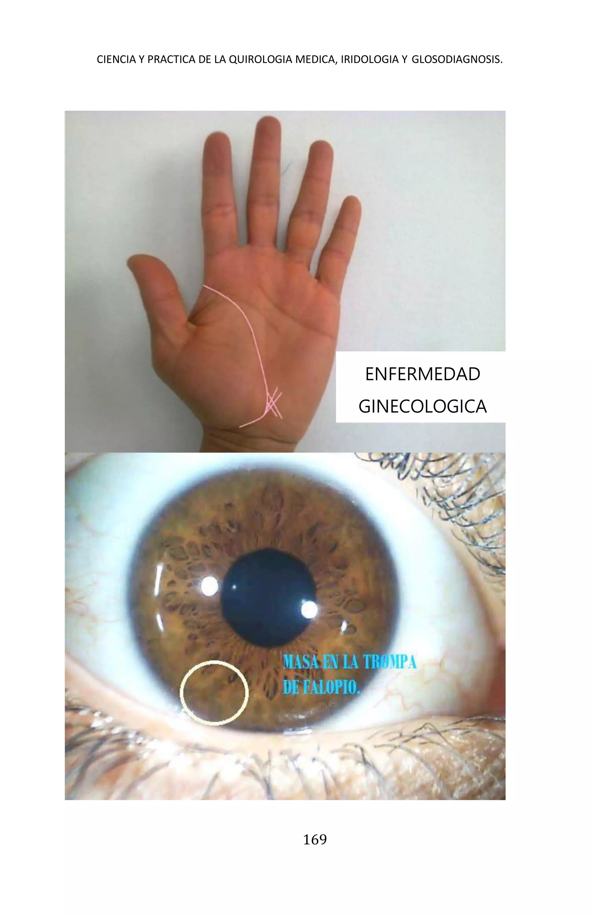 CIENCIA Y PRACTICA DE LA QUIROLOGIA MEDICA, IRIDOLOGIA Y GLOSODIAGNOSIS.
169
ENFERMEDAD
GINECOLOGICA
 