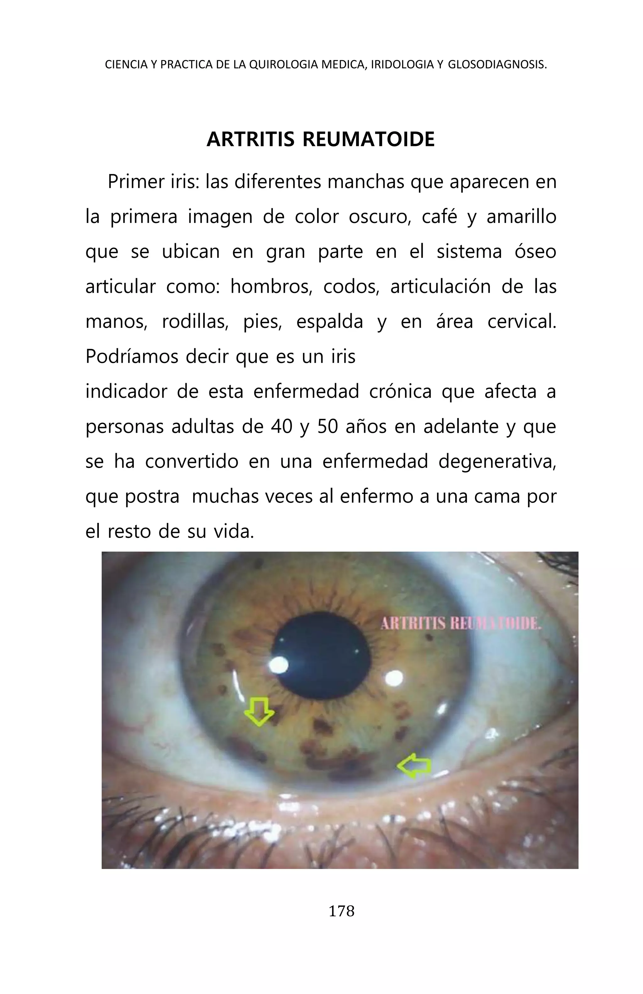 CIENCIA Y PRACTICA DE LA QUIROLOGIA MEDICA, IRIDOLOGIA Y GLOSODIAGNOSIS.
178
ARTRITIS REUMATOIDE
Primer iris: las diferentes manchas que aparecen en
la primera imagen de color oscuro, café y amarillo
que se ubican en gran parte en el sistema óseo
articular como: hombros, codos, articulación de las
manos, rodillas, pies, espalda y en área cervical.
Podríamos decir que es un iris
indicador de esta enfermedad crónica que afecta a
personas adultas de 40 y 50 años en adelante y que
se ha convertido en una enfermedad degenerativa,
que postra muchas veces al enfermo a una cama por
el resto de su vida.
 