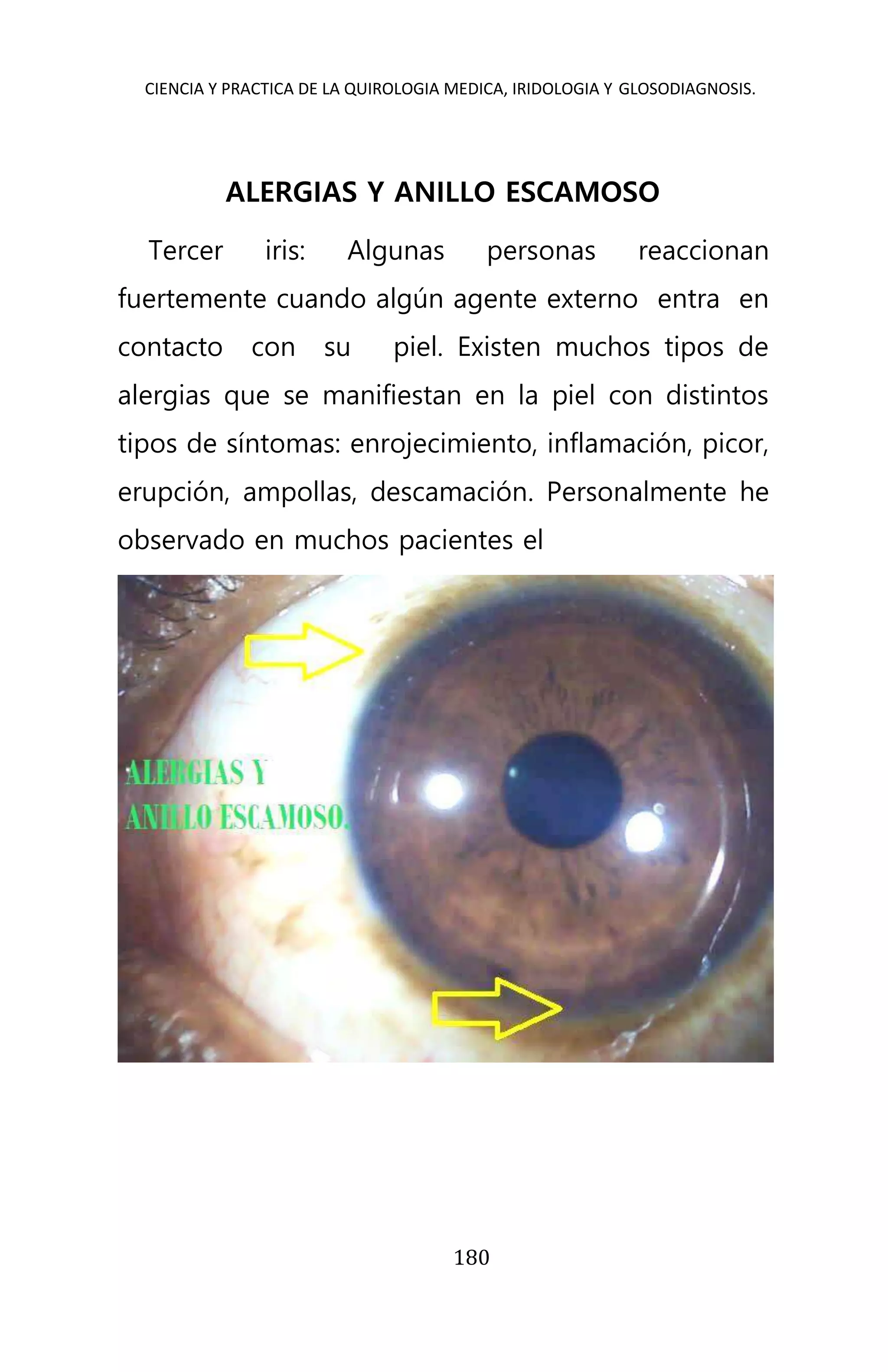 CIENCIA Y PRACTICA DE LA QUIROLOGIA MEDICA, IRIDOLOGIA Y GLOSODIAGNOSIS.
180
ALERGIAS Y ANILLO ESCAMOSO
Tercer iris: Algunas personas reaccionan
fuertemente cuando algún agente externo entra en
contacto con su piel. Existen muchos tipos de
alergias que se manifiestan en la piel con distintos
tipos de síntomas: enrojecimiento, inflamación, picor,
erupción, ampollas, descamación. Personalmente he
observado en muchos pacientes el
 