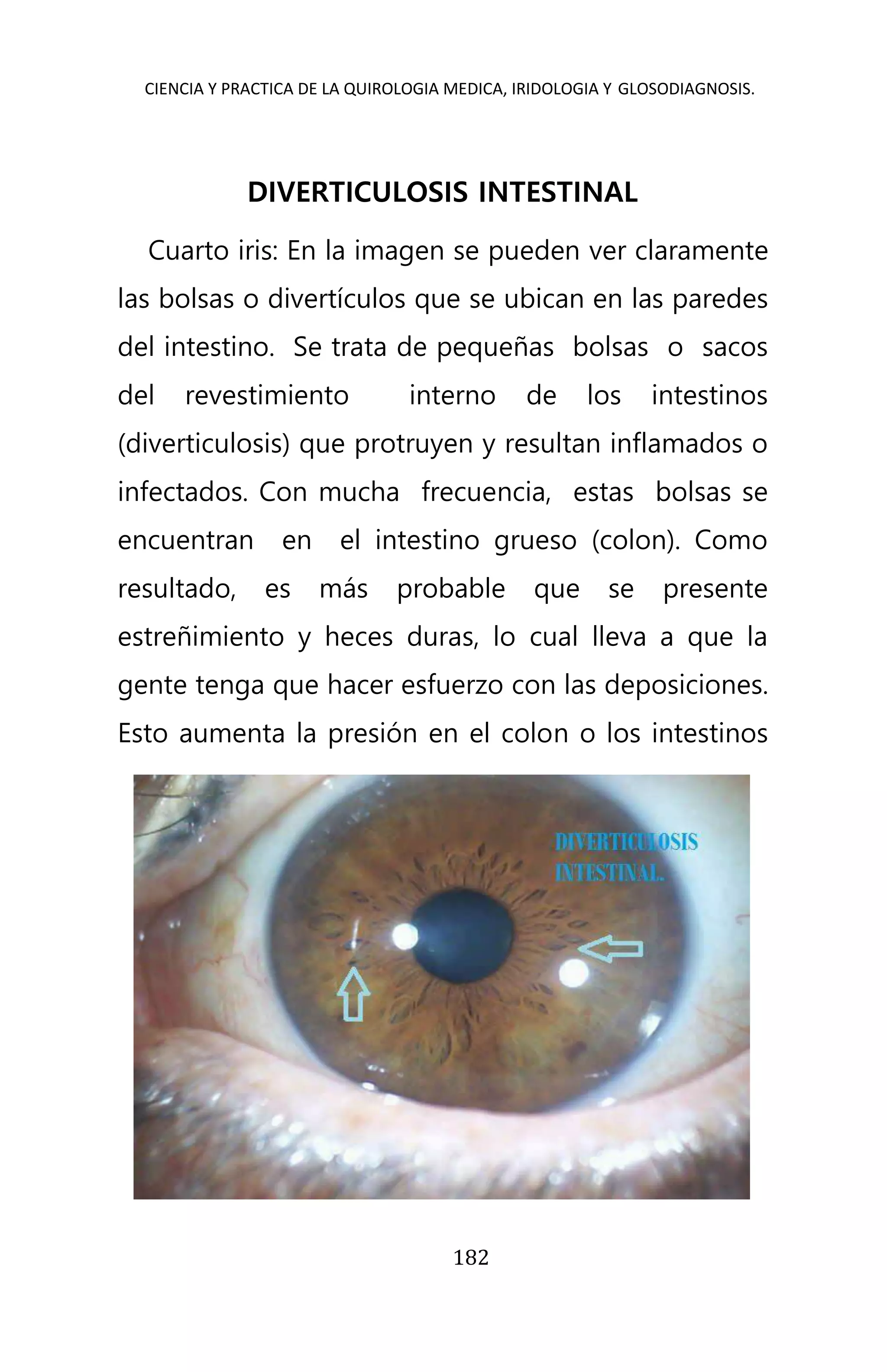 CIENCIA Y PRACTICA DE LA QUIROLOGIA MEDICA, IRIDOLOGIA Y GLOSODIAGNOSIS.
182
DIVERTICULOSIS INTESTINAL
Cuarto iris: En la imagen se pueden ver claramente
las bolsas o divertículos que se ubican en las paredes
del intestino. Se trata de pequeñas bolsas o sacos
del revestimiento interno de los intestinos
(diverticulosis) que protruyen y resultan inflamados o
infectados. Con mucha frecuencia, estas bolsas se
encuentran en el intestino grueso (colon). Como
resultado, es más probable que se presente
estreñimiento y heces duras, lo cual lleva a que la
gente tenga que hacer esfuerzo con las deposiciones.
Esto aumenta la presión en el colon o los intestinos
 