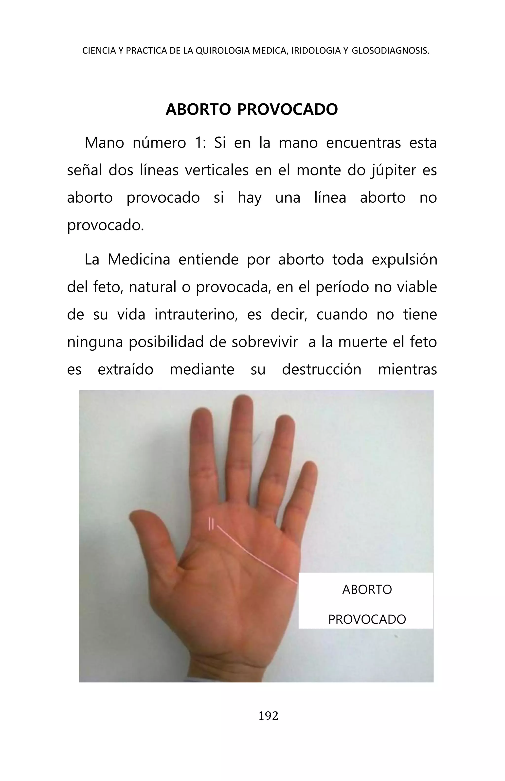 CIENCIA Y PRACTICA DE LA QUIROLOGIA MEDICA, IRIDOLOGIA Y GLOSODIAGNOSIS.
192
ABORTO PROVOCADO
Mano número 1: Si en la mano encuentras esta
señal dos líneas verticales en el monte do júpiter es
aborto provocado si hay una línea aborto no
provocado.
La Medicina entiende por aborto toda expulsión
del feto, natural o provocada, en el período no viable
de su vida intrauterino, es decir, cuando no tiene
ninguna posibilidad de sobrevivir a la muerte el feto
es extraído mediante su destrucción mientras
ABORTO
PROVOCADO
 