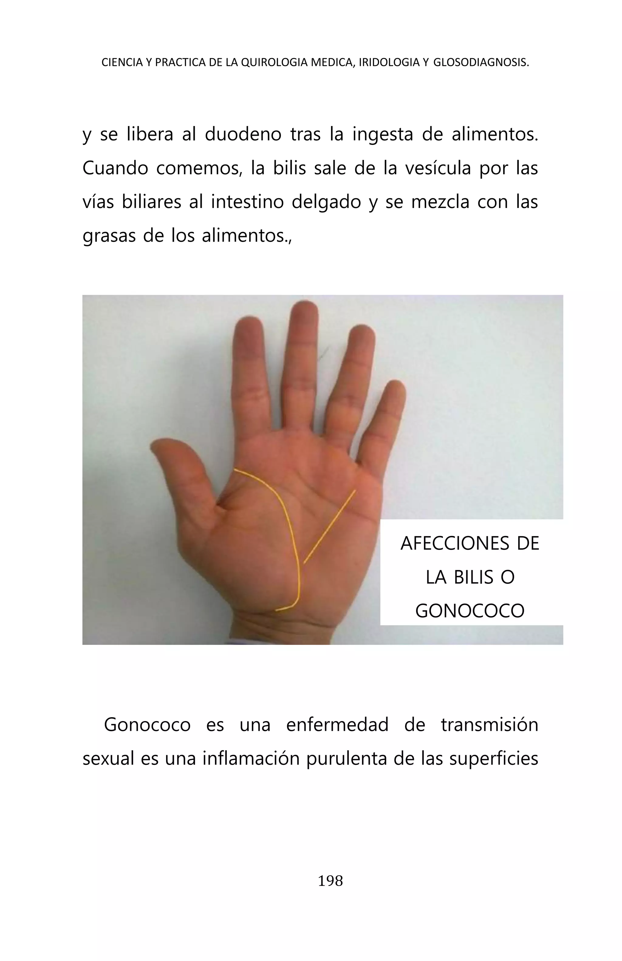 CIENCIA Y PRACTICA DE LA QUIROLOGIA MEDICA, IRIDOLOGIA Y GLOSODIAGNOSIS.
198
y se libera al duodeno tras la ingesta de alimentos.
Cuando comemos, la bilis sale de la vesícula por las
vías biliares al intestino delgado y se mezcla con las
grasas de los alimentos.,
Gonococo es una enfermedad de transmisión
sexual es una inflamación purulenta de las superficies
AFECCIONES DE
LA BILIS O
GONOCOCO
 