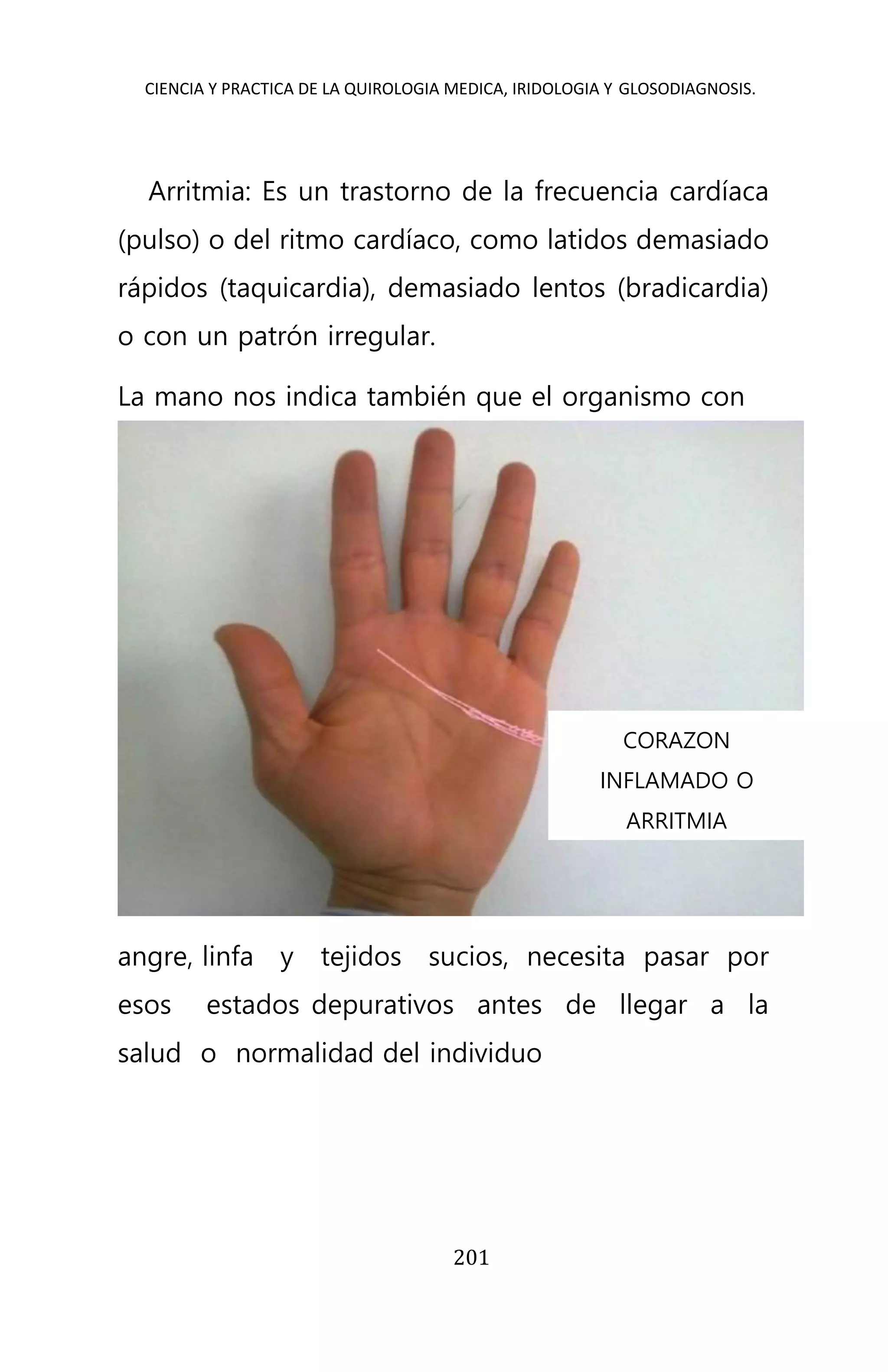CIENCIA Y PRACTICA DE LA QUIROLOGIA MEDICA, IRIDOLOGIA Y GLOSODIAGNOSIS.
201
Arritmia: Es un trastorno de la frecuencia cardíaca
(pulso) o del ritmo cardíaco, como latidos demasiado
rápidos (taquicardia), demasiado lentos (bradicardia)
o con un patrón irregular.
La mano nos indica también que el organismo con
angre, linfa y tejidos sucios, necesita pasar por
esos estados depurativos antes de llegar a la
salud o normalidad del individuo
CORAZON
INFLAMADO O
ARRITMIA
 