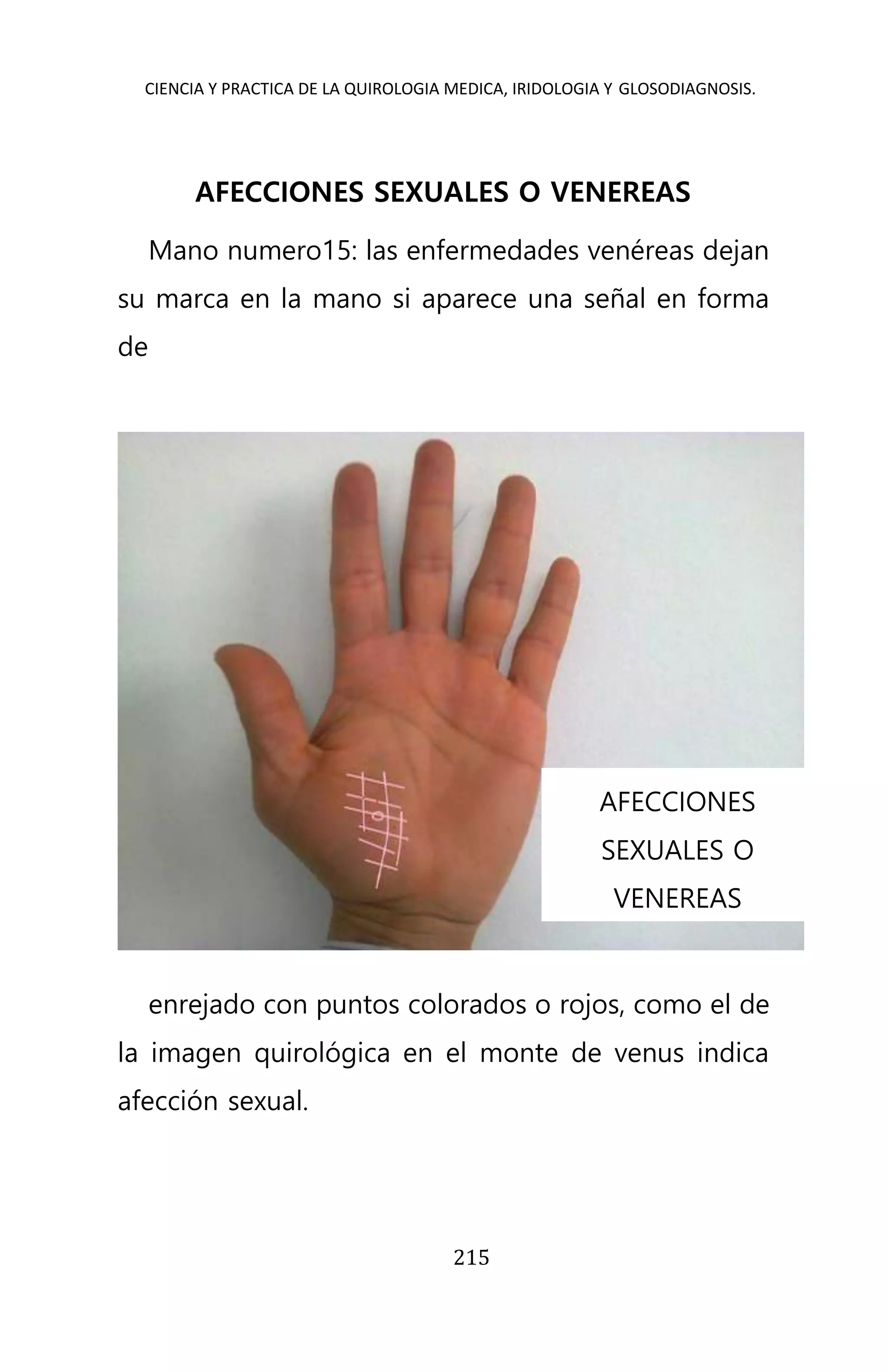 CIENCIA Y PRACTICA DE LA QUIROLOGIA MEDICA, IRIDOLOGIA Y GLOSODIAGNOSIS.
215
AFECCIONES SEXUALES O VENEREAS
Mano numero15: las enfermedades venéreas dejan
su marca en la mano si aparece una señal en forma
de
enrejado con puntos colorados o rojos, como el de
la imagen quirológica en el monte de venus indica
afección sexual.
AFECCIONES
SEXUALES O
VENEREAS
 