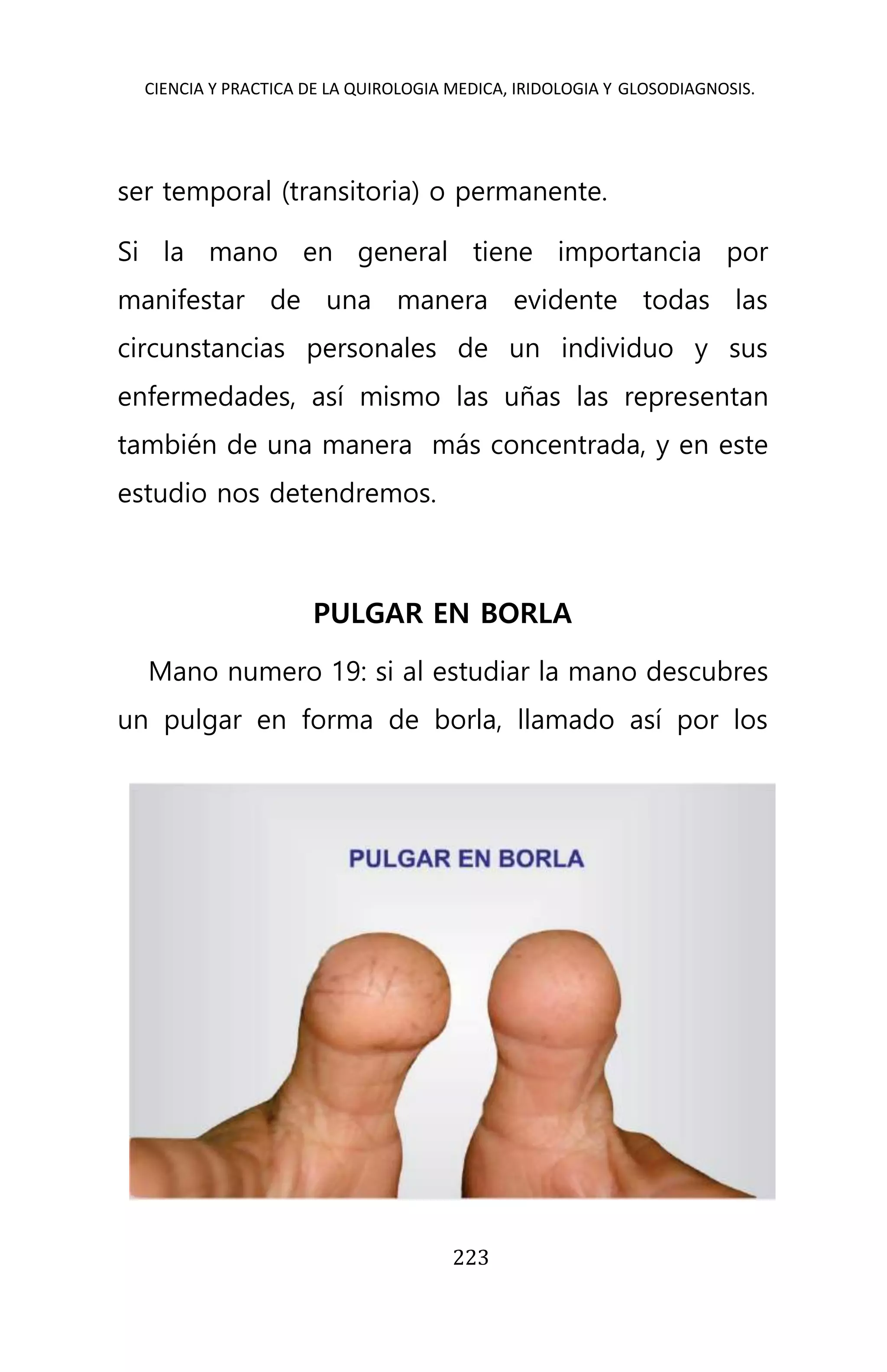 CIENCIA Y PRACTICA DE LA QUIROLOGIA MEDICA, IRIDOLOGIA Y GLOSODIAGNOSIS.
223
ser temporal (transitoria) o permanente.
Si la mano en general tiene importancia por
manifestar de una manera evidente todas las
circunstancias personales de un individuo y sus
enfermedades, así mismo las uñas las representan
también de una manera más concentrada, y en este
estudio nos detendremos.
PULGAR EN BORLA
Mano numero 19: si al estudiar la mano descubres
un pulgar en forma de borla, llamado así por los
 