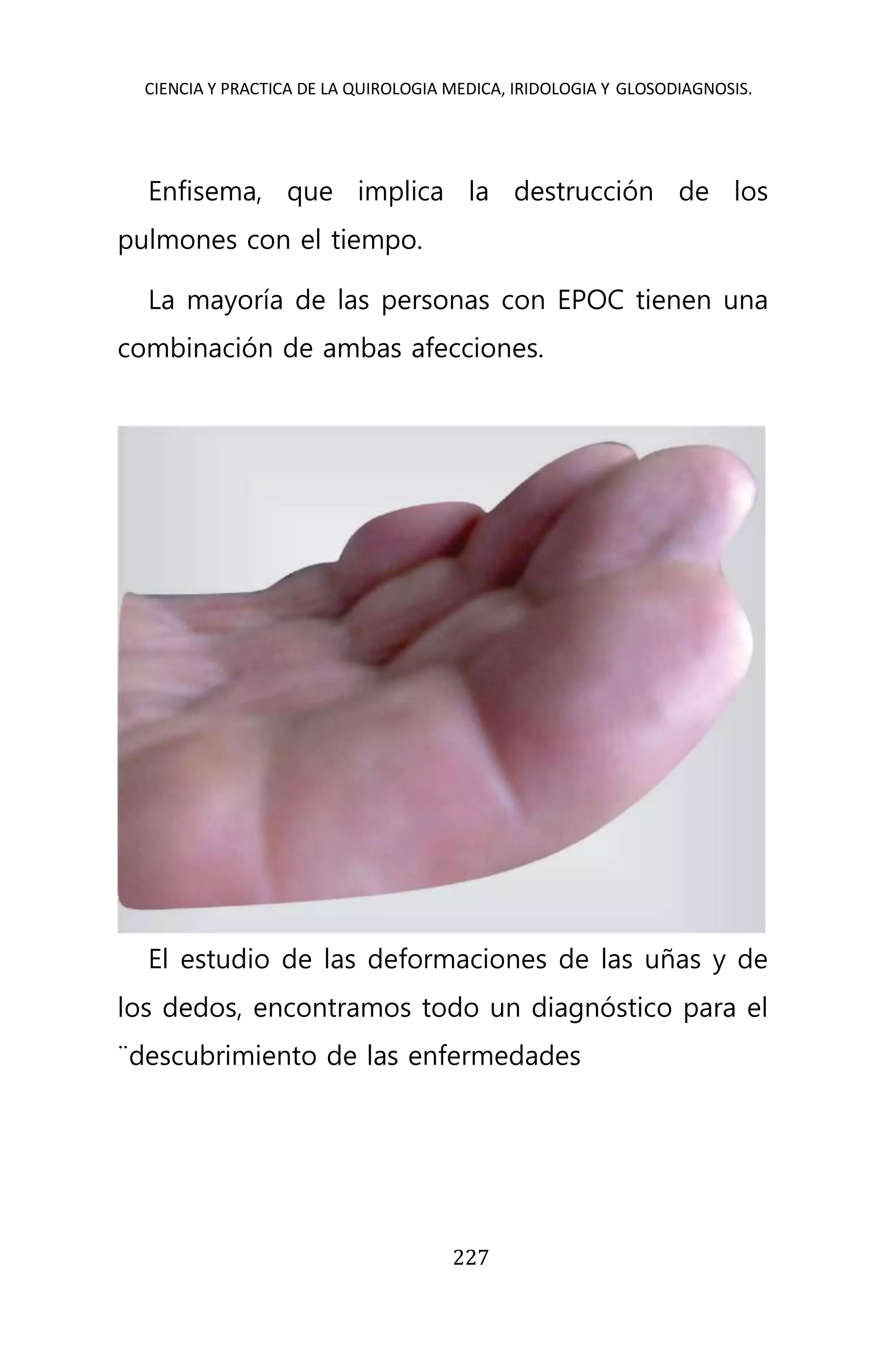 CIENCIA Y PRACTICA DE LA QUIROLOGIA MEDICA, IRIDOLOGIA Y GLOSODIAGNOSIS.
227
Enfisema, que implica la destrucción de los
pulmones con el tiempo.
La mayoría de las personas con EPOC tienen una
combinación de ambas afecciones.
El estudio de las deformaciones de las uñas y de
los dedos, encontramos todo un diagnóstico para el
¨descubrimiento de las enfermedades
 