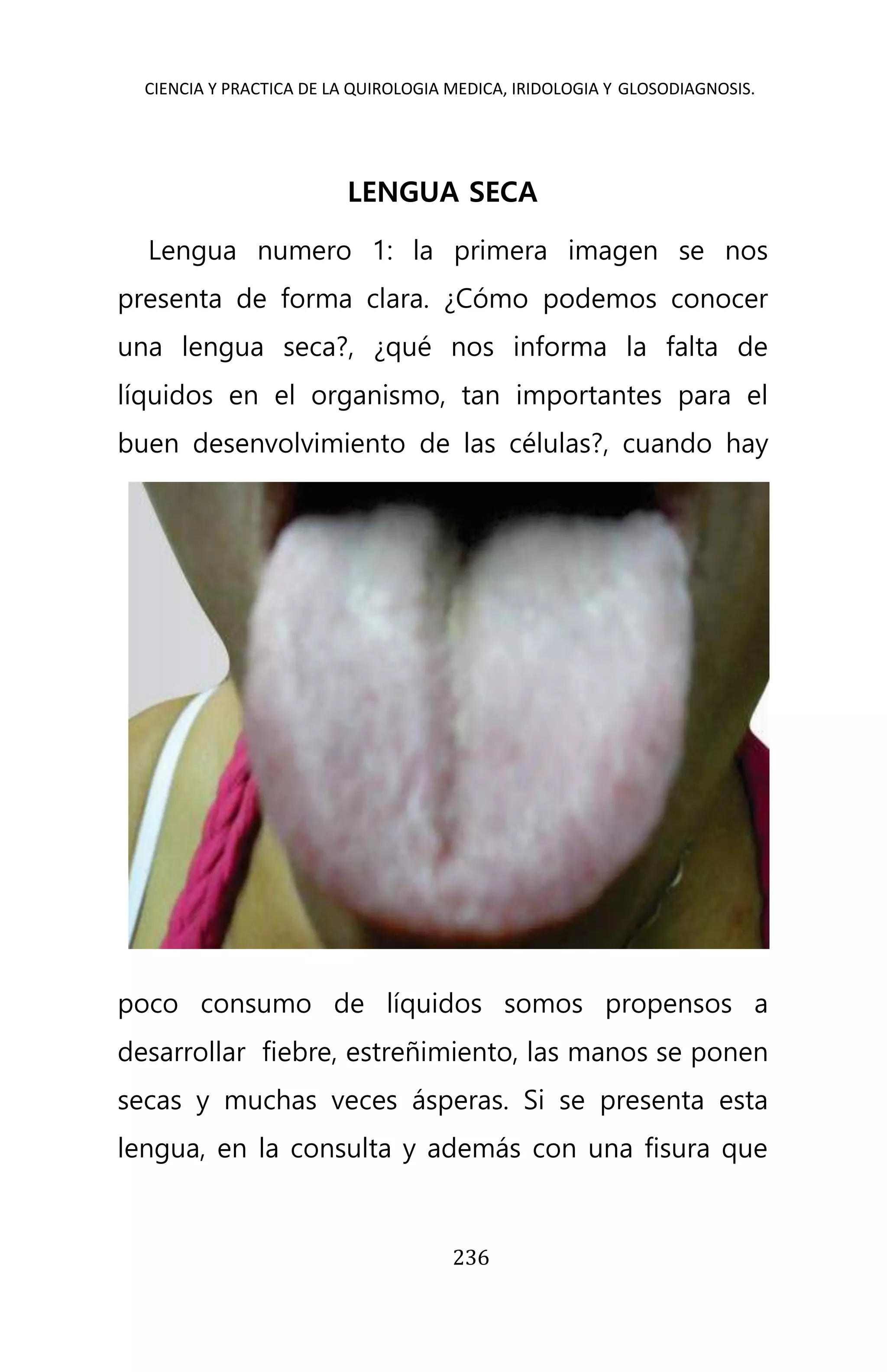 CIENCIA Y PRACTICA DE LA QUIROLOGIA MEDICA, IRIDOLOGIA Y GLOSODIAGNOSIS.
236
LENGUA SECA
Lengua numero 1: la primera imagen se nos
presenta de forma clara. ¿Cómo podemos conocer
una lengua seca?, ¿qué nos informa la falta de
líquidos en el organismo, tan importantes para el
buen desenvolvimiento de las células?, cuando hay
poco consumo de líquidos somos propensos a
desarrollar fiebre, estreñimiento, las manos se ponen
secas y muchas veces ásperas. Si se presenta esta
lengua, en la consulta y además con una fisura que
 