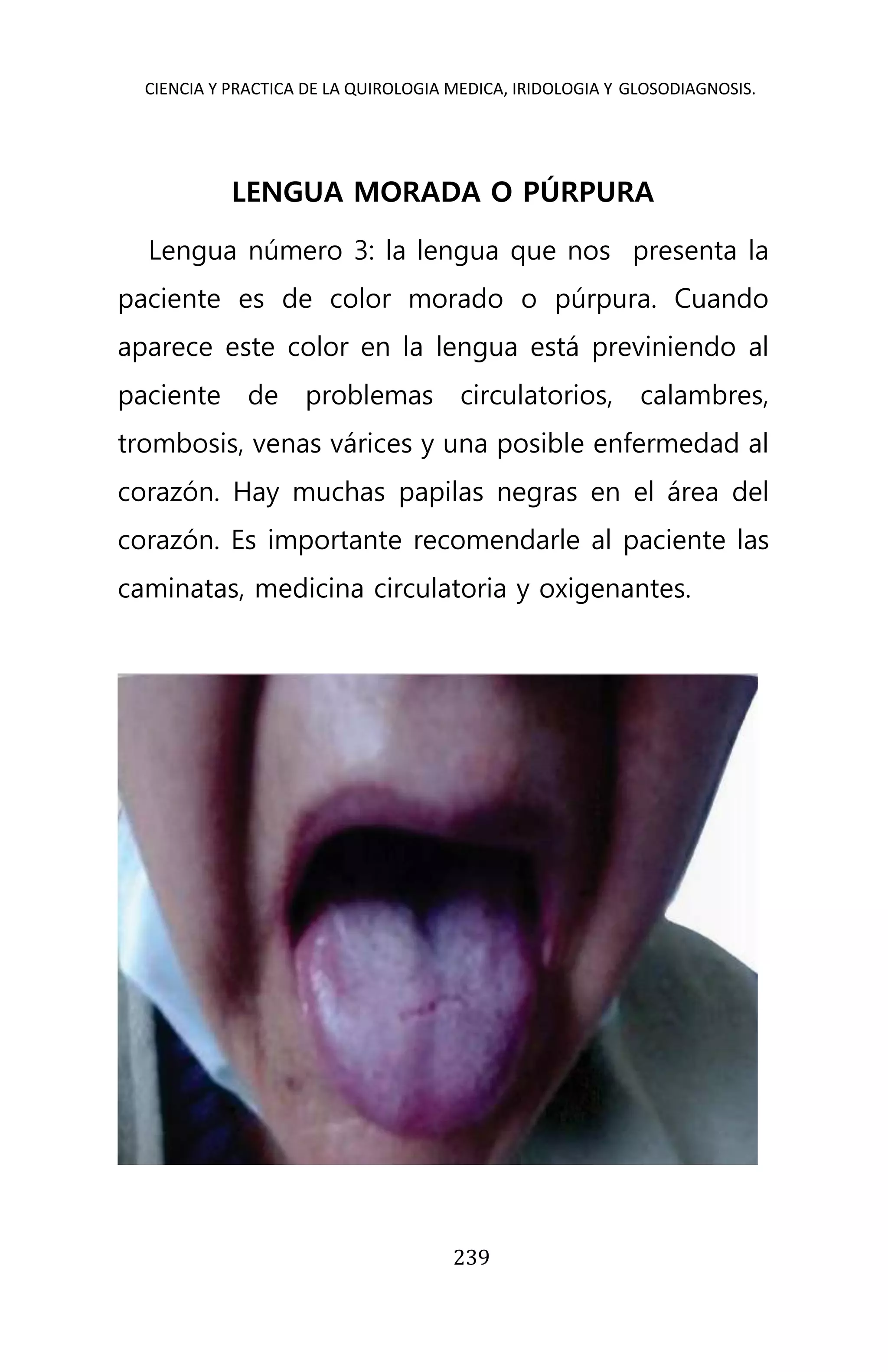CIENCIA Y PRACTICA DE LA QUIROLOGIA MEDICA, IRIDOLOGIA Y GLOSODIAGNOSIS.
239
LENGUA MORADA O PÚRPURA
Lengua número 3: la lengua que nos presenta la
paciente es de color morado o púrpura. Cuando
aparece este color en la lengua está previniendo al
paciente de problemas circulatorios, calambres,
trombosis, venas várices y una posible enfermedad al
corazón. Hay muchas papilas negras en el área del
corazón. Es importante recomendarle al paciente las
caminatas, medicina circulatoria y oxigenantes.
 