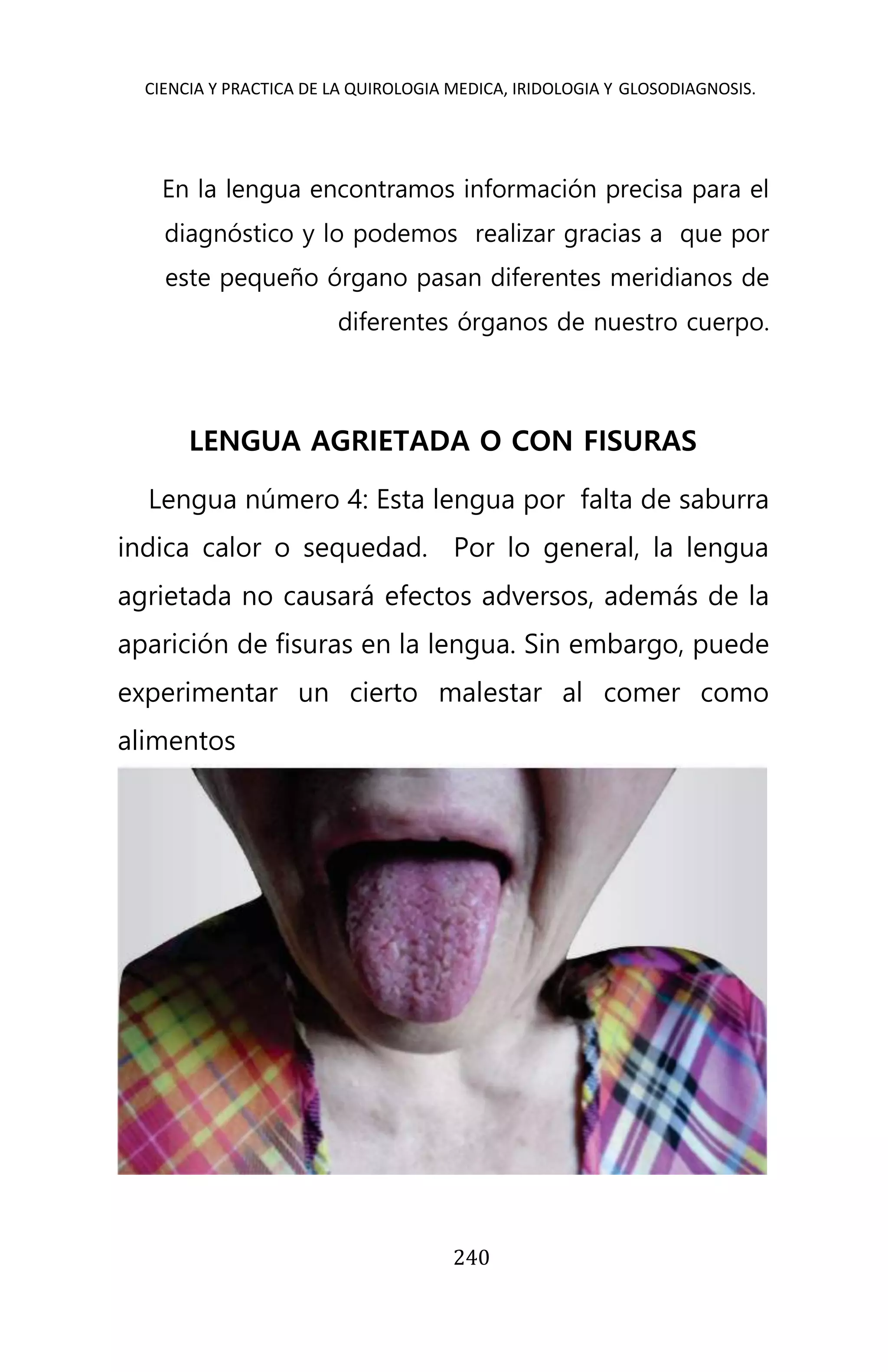 CIENCIA Y PRACTICA DE LA QUIROLOGIA MEDICA, IRIDOLOGIA Y GLOSODIAGNOSIS.
240
En la lengua encontramos información precisa para el
diagnóstico y lo podemos realizar gracias a que por
este pequeño órgano pasan diferentes meridianos de
diferentes órganos de nuestro cuerpo.
LENGUA AGRIETADA O CON FISURAS
Lengua número 4: Esta lengua por falta de saburra
indica calor o sequedad. Por lo general, la lengua
agrietada no causará efectos adversos, además de la
aparición de fisuras en la lengua. Sin embargo, puede
experimentar un cierto malestar al comer como
alimentos
 