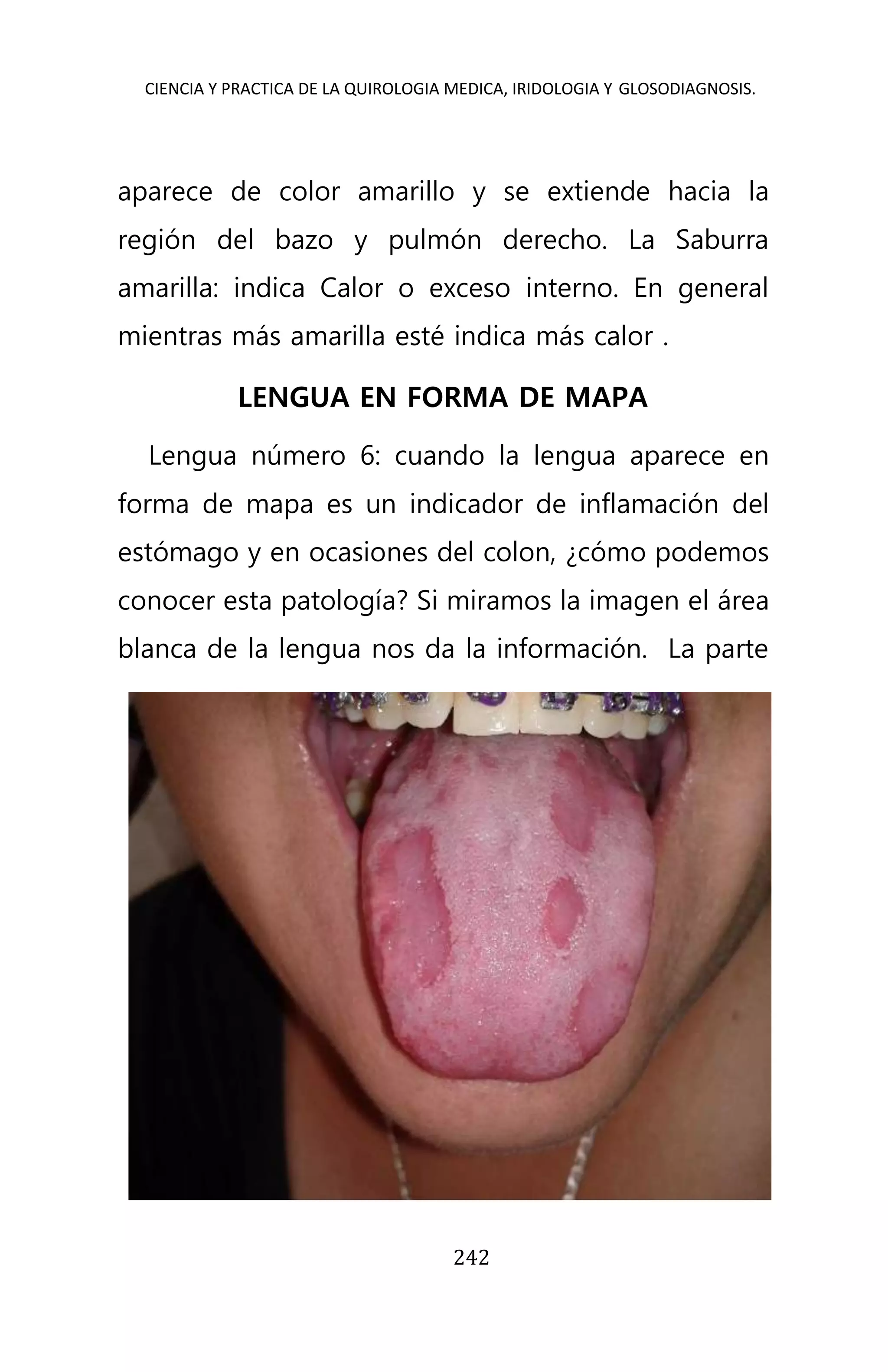 CIENCIA Y PRACTICA DE LA QUIROLOGIA MEDICA, IRIDOLOGIA Y GLOSODIAGNOSIS.
242
aparece de color amarillo y se extiende hacia la
región del bazo y pulmón derecho. La Saburra
amarilla: indica Calor o exceso interno. En general
mientras más amarilla esté indica más calor .
LENGUA EN FORMA DE MAPA
Lengua número 6: cuando la lengua aparece en
forma de mapa es un indicador de inflamación del
estómago y en ocasiones del colon, ¿cómo podemos
conocer esta patología? Si miramos la imagen el área
blanca de la lengua nos da la información. La parte
 