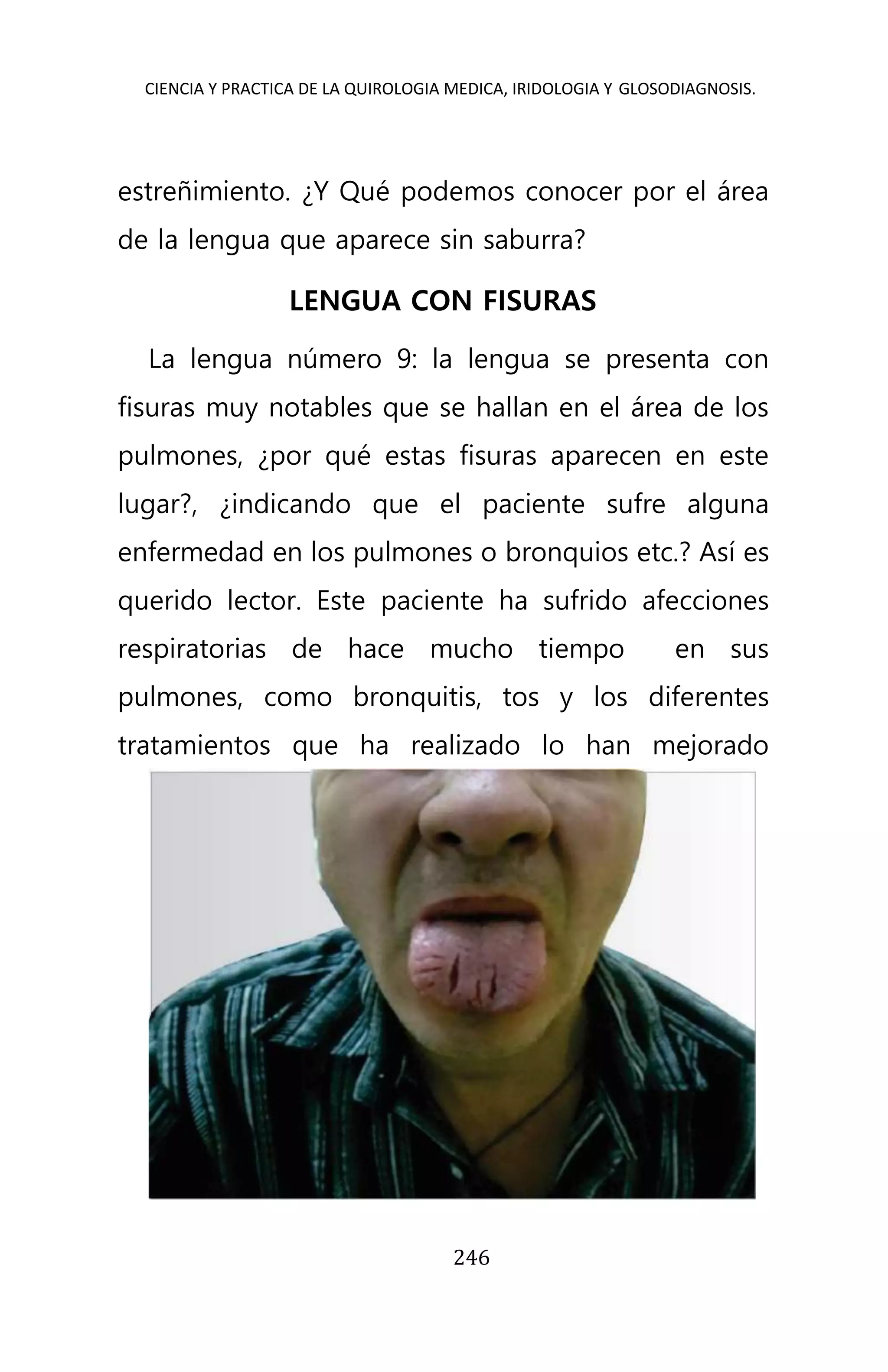 CIENCIA Y PRACTICA DE LA QUIROLOGIA MEDICA, IRIDOLOGIA Y GLOSODIAGNOSIS.
246
estreñimiento. ¿Y Qué podemos conocer por el área
de la lengua que aparece sin saburra?
LENGUA CON FISURAS
La lengua número 9: la lengua se presenta con
fisuras muy notables que se hallan en el área de los
pulmones, ¿por qué estas fisuras aparecen en este
lugar?, ¿indicando que el paciente sufre alguna
enfermedad en los pulmones o bronquios etc.? Así es
querido lector. Este paciente ha sufrido afecciones
respiratorias de hace mucho tiempo en sus
pulmones, como bronquitis, tos y los diferentes
tratamientos que ha realizado lo han mejorado
 