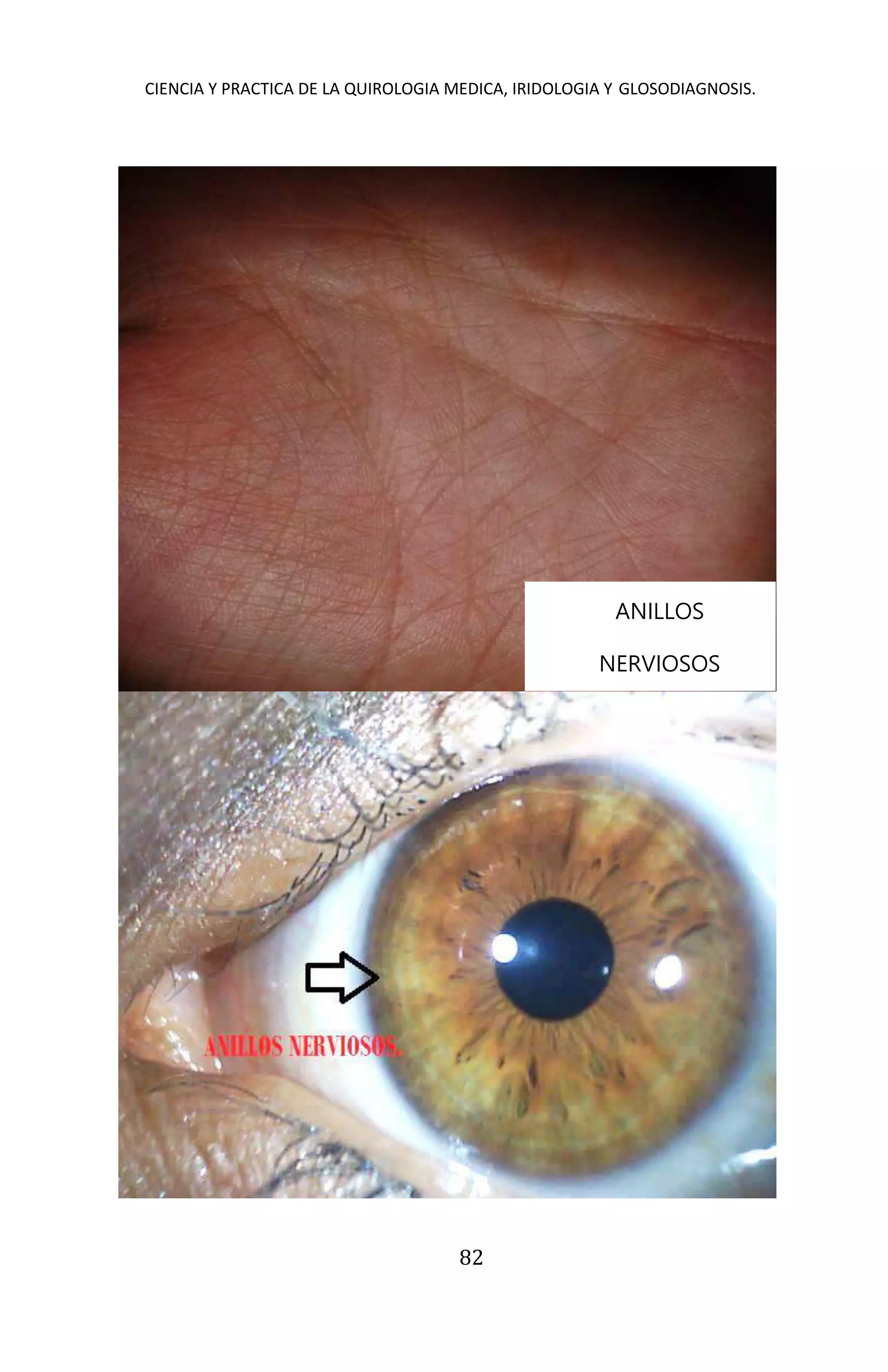 CIENCIA Y PRACTICA DE LA QUIROLOGIA MEDICA, IRIDOLOGIA Y GLOSODIAGNOSIS.
82
ANILLOS
NERVIOSOS
 