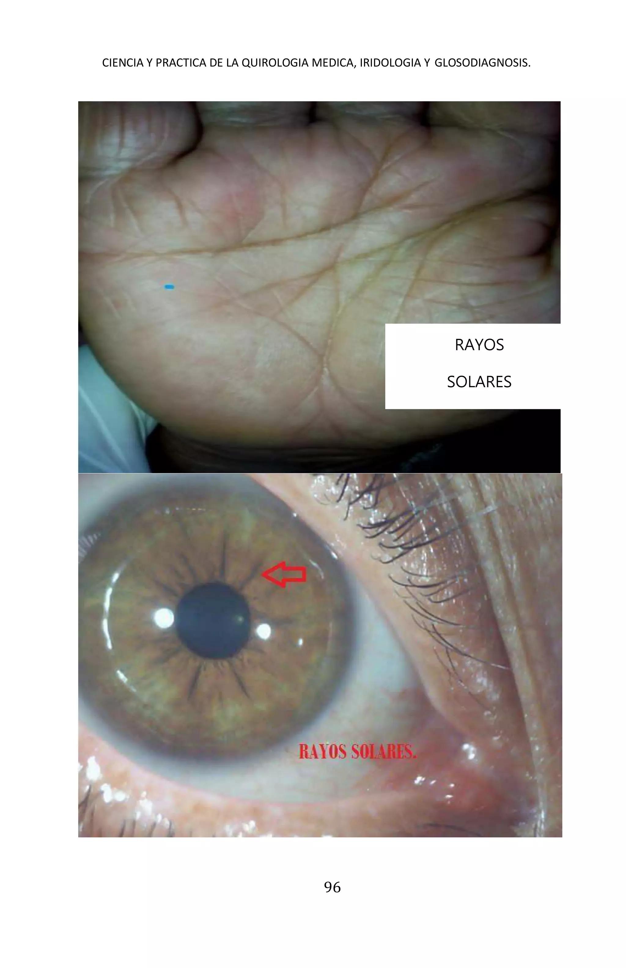 CIENCIA Y PRACTICA DE LA QUIROLOGIA MEDICA, IRIDOLOGIA Y GLOSODIAGNOSIS.
96
RAYOS
SOLARES
 