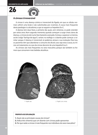 DOCUMENTOS DE AMPLIAÇÃO                CIÊNCIAS DA NATUREZA 6 | CADERNO DE APOIO AO PROFESSOR

                                          ar
                                      ão p a a S

     26                             aç




                                               aú
                                c
                             Edu




                                                 de
          A cirrose é irreversível
              A cirrose é uma doença crónica e irreversível do fígado, em que as células nor-
          mais sofrem uma lesão e são substituídas por cicatrizes. A causa mais frequente
          desta patologia é o alcoolismo, a que se seguem as hepatites B e C.
              A doença tem duas fases, a primeira das quais, sem sintomas, se pode estender
          por vários anos. Num segundo momento, quando começam a surgir sinais claros de
          doença, a cirrose já está numa fase bastante avançada. Começa a aparecer a icterícia,
          ascite (vulgo “barriga-de-água”), varizes no esófago e o doente pode começar a vo-
          mitar sangue. A doença é irreversível, só podemos atrasar a sua evolução. Para isso,
          os pacientes têm que abandonar o consumo do álcool, caso seja esta a causa, ou ini-
          ciar um tratamento, no caso da cirrose decorrer de uma hepatite B ou C.
              As cirroses são mais frequentes no sexo masculino, porque são também os ho-
          mens que consomem mais bebidas alcoólicas.




                        1. Fígado são.                             2. Fígado com cirrose.




            PROPOSTA DE EXPLORAÇÃO

            1. Quais são as principais causas da cirrose?
            2. Indica três sintomas que um doente com cirrose pode apresentar.
            3. Por que razão a cirrose é mais frequente nos indivíduos do sexo masculino?

52
 