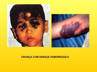 CRIANÇA COM DENGUE HEMORRÁGICA 