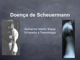 Doença de Scheuermann

    Guilherme Wentz Biasuz
    Ortopedia e Tramatologia
 