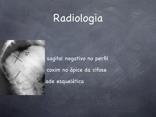 Radiologia


balanço sagital negativo no perﬁl

Rx com coxim no ápice da cifose

maturidade esquelética
 