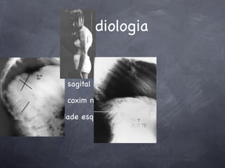 Radiologia


balanço sagital negativo no perﬁl

Rx com coxim no ápice da cifose

maturidade esquelética
 