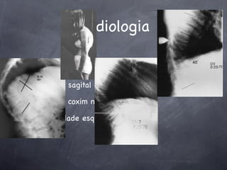 Radiologia


balanço sagital negativo no perﬁl

Rx com coxim no ápice da cifose

maturidade esquelética
 