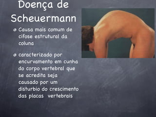 Doença de
Scheuermann
 Causa mais comum de
 cifose estrutural da
 coluna

 caracterizado por
 encurvamento em cunha
 do corpo vertebral que
 se acredita seja
 causado por um
 disturbio do crescimento
 das placas vertebrais
 
