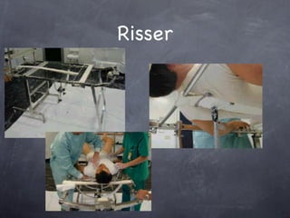 Risser
 