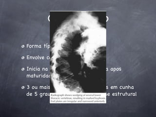 Classiﬁcação

Forma típica:

Envolve coluna torácica

Inicia na adolescência e continua apos
maturidade esquelética

3 ou mais vertebras consecutivas em cunha
de 5 graus produzindo uma cifose estrutural
 