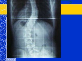 Curvas secundarias o compensadoras.