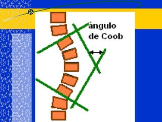 Inclinación de la pelvis.