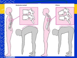 15%: progresivo, coexistiendo con inicio tardío (> 1a), incurvaciones > 35°2. 	JUVENIL: (4 años – pubertad) 