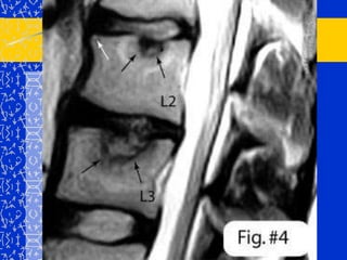 ESCOLIOSIS CONGENITAEscoliosis debida o asociada a anomalías de la formación o segmentación de las vértebras.	- 25% no progresivas	- 25% progreso moderado	- 50% progresivasPuede acompañarse de malformaciones genito-urinarias, cardiopatías congénitas (síndrome Klippel-Feil, síndrome Vater, síndrome Goldenhar, disrafismo vertebral.
