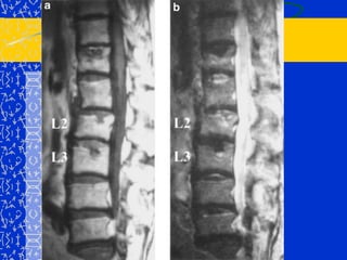 TRATAMIENTOConservador: aparato de Milwaukee.Quirúrgico: Hemiartrodesis anterior y posterior
