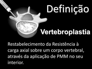 Definição Vertebroplastia	Restabelecimento da Resistência à carga axial sobre um corpo vertebral, através da aplicação de PMM no seu interior.