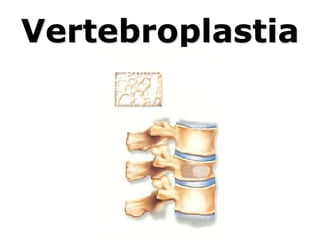 Vertebroplastia
