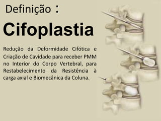 Definição :CifoplastiaRedução da Deformidade Cifótica e Criação de Cavidade para receber PMM no Interior do Corpo Vertebral, para Restabelecimento da Resistência à carga axial e Biomecânica da Coluna.