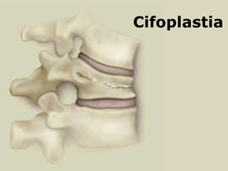 Cifoplastia