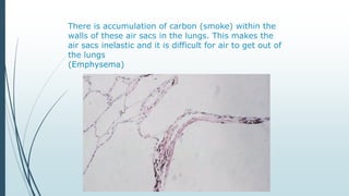 There is accumulation of carbon (smoke) within the
walls of these air sacs in the lungs. This makes the
air sacs inelastic and it is difficult for air to get out of
the lungs
(Emphysema)
 